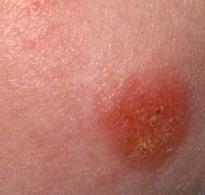 strep skin infections pictures