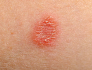 Round spots of dry skin - Dermatology - MedHelp
